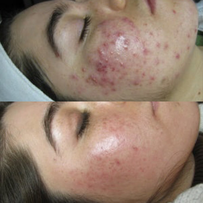 Teenage Acne: It’s More than Skin Deep